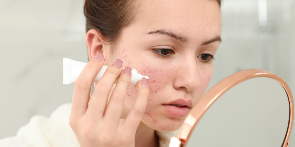 Different Ways To Help Repair Acne-Damaged Skin in Bangkok